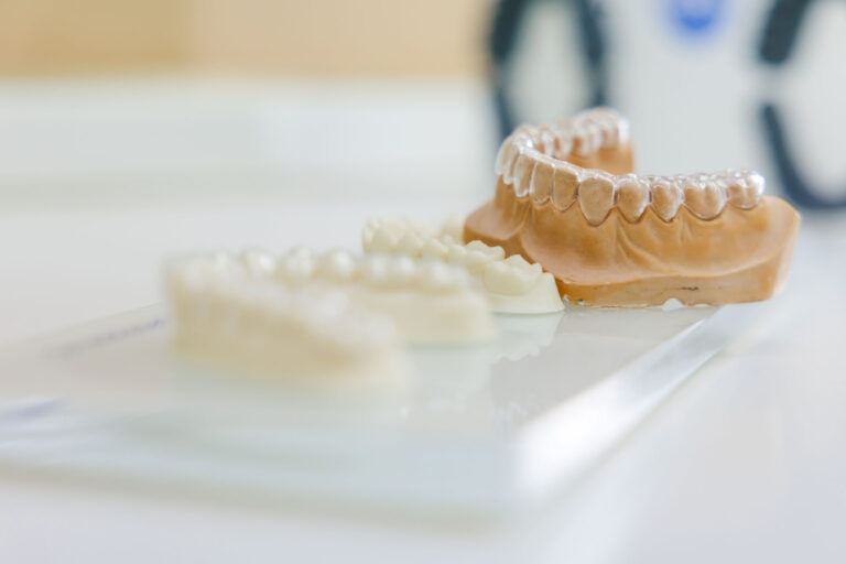 Veneers | Zahnarzt Schwäbisch Gmünd